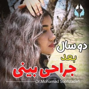 rhinoplasty-16