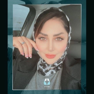 rhinoplasty-20