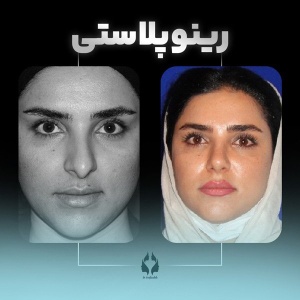 rhinoplasty-22