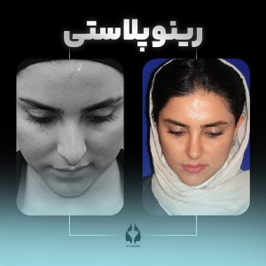 rhinoplasty-23