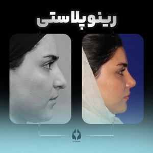 rhinoplasty-24