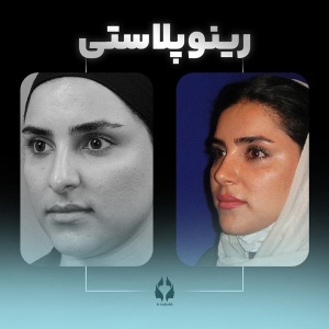rhinoplasty-25