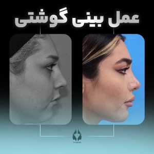rhinoplasty-26
