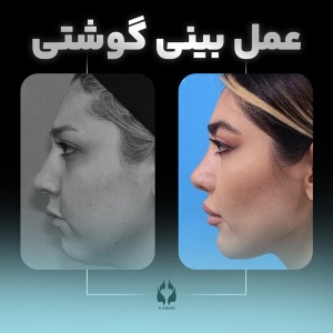 rhinoplasty-27-1