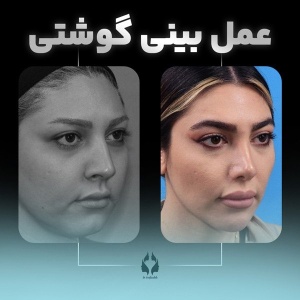 rhinoplasty-28-1