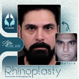 rhinoplasty-5