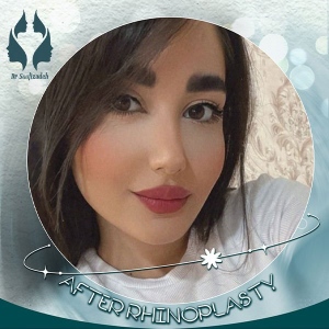 rhinoplasty-6