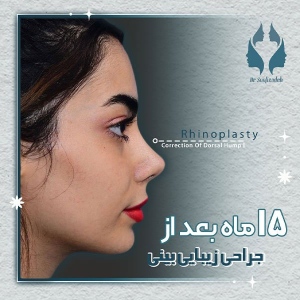 rhinoplasty-7