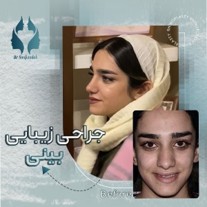 rhinoplasty-8