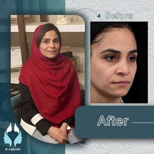 rhinoplasty-9