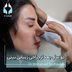 rhinoplasty12