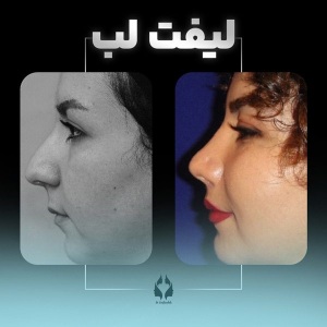 lip-lift-1