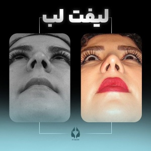 lip-lift-2