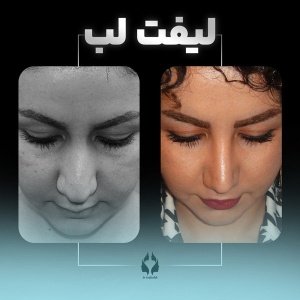 lip-lift-3