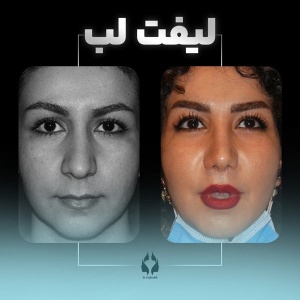 lip-lift-4