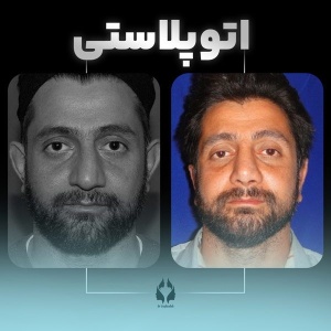 otoplasty-1