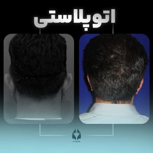 otoplasty-3