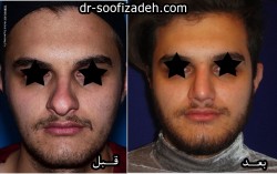جراحی بینی