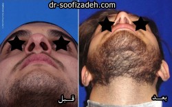 جراحی زیبایی بینی
