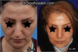 عمل بینی