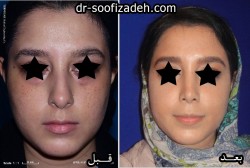 جراحی بینی دکتر صوفی زاده