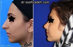 جراحی بینی