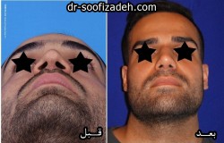 جراحی بینی طبیعی مردانه