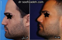 جراحی بینی دکتر صوفی زاده