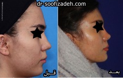 نمونه جراحی بینی دکتر صوفی زاده
