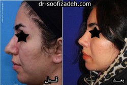 نمونه جراحی بینی