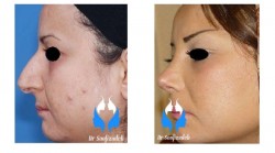 عوارض جراحی زیبایی بینی استخوانی