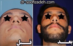 جراحی بینی