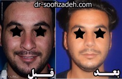 بینی مردانه طبیعی
