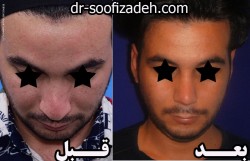 جراحی بینی طبیعی