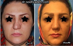 جراحی نوک بینی