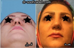 عمل نوک بینی
