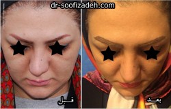نمونه جراحی نوک بینی
