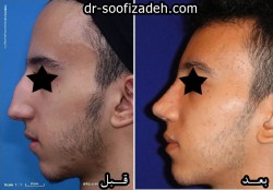 جراحی نوک بینی مردان