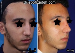 عمل جراحی نوک بینی مردان