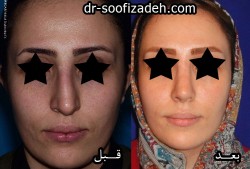جراحی انحراف بینی