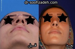رفع انحراف بینی