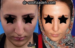 عمل جراحی انحراف بینی