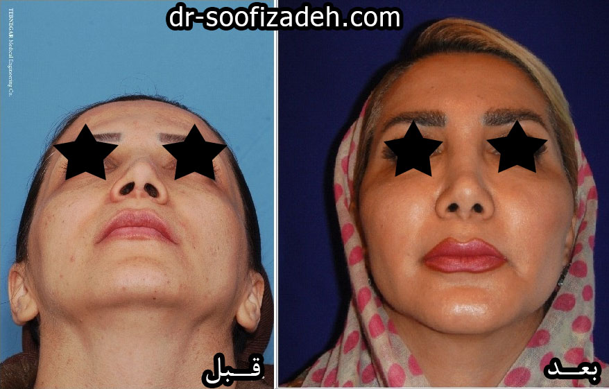 نمونه کار اصلاح فرم بینی