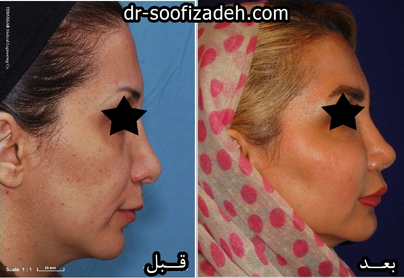 نمونه کار اصلاح فرم بینی با ژل