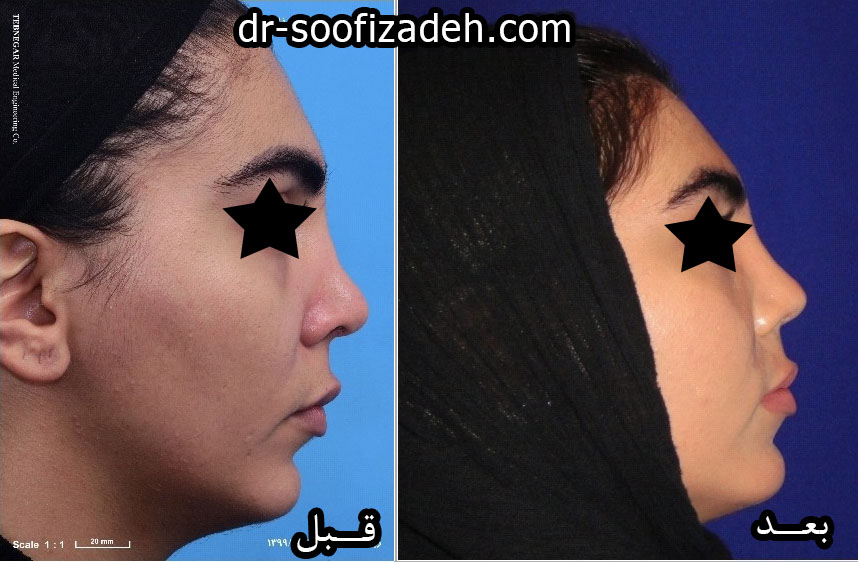 اصلاح فرم بینی
