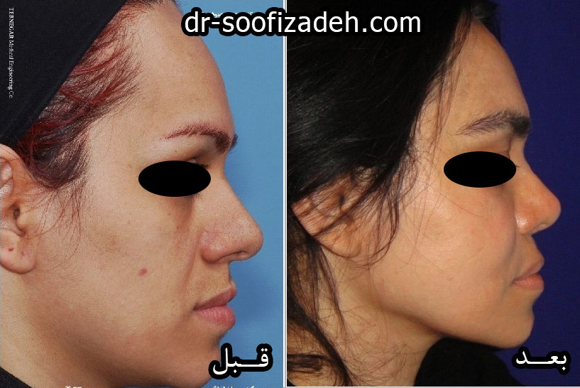 تزریق ژل