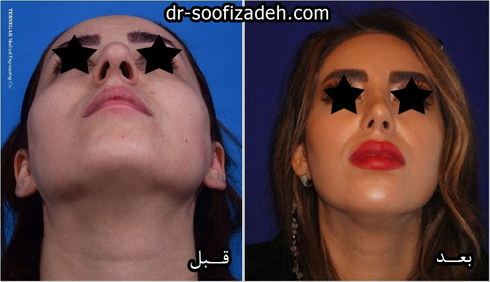 نمونه جراحی بینی گنده