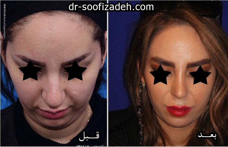 نمونه جراحی بینی گنده دکتر صوفی زاده