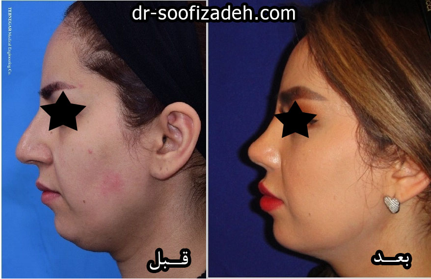 نمونه جراحی دماغ گنده