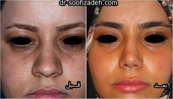 لیفت ابرو دکتر صوفی زاده